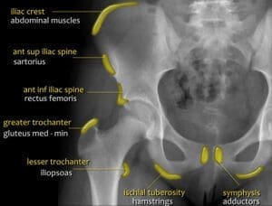 pelvis-avulsion-fractures youth pelvis hip avulsion
