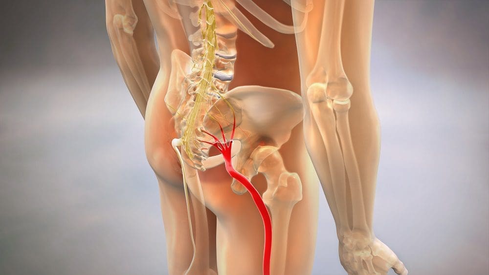 Sciatic Pinched Nerve 3D Render