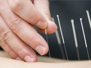 dry-needling-acupuncture Acupuncture needle placement in upper back by physiotherapist