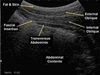 Patient receiving Real-Time Ultrasound Physiotherapy for lower back pain
