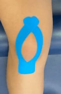 Patella dislocation physiotherapy taping to support kneecap alignment during rehabilitation