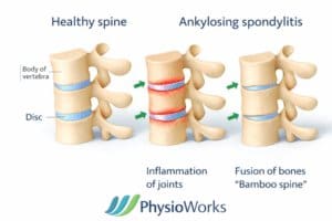 Ankylosing spondylitis spine showing inflammation and bamboo spine compared to healthy vertebrae