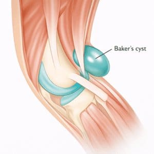 Baker’s cyst physiotherapy: swelling behind the knee illustration