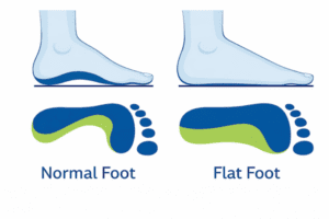Flat foot vs normal foot footprint comparison showing pes planus arch collapse