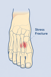 foot-stress-fracture-metatarsal-physioworks Foot stress fracture affecting the second metatarsal