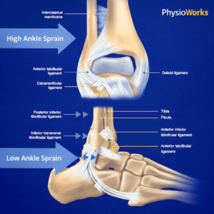 High ankle sprain anatomy showing syndesmosis ligaments above the ankle joint