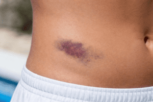 Hip pointer injury showing bruising over the iliac crest