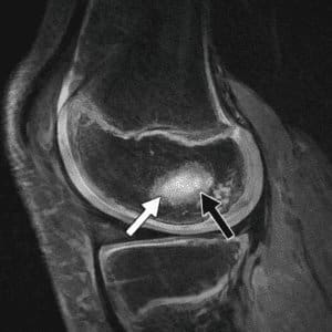 Juvenile osteochondritis dissecans knee lesion shown on MRI