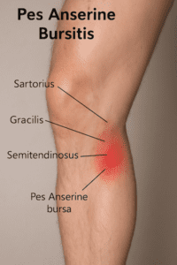 Pes anserine bursitis redness on lower inner knee