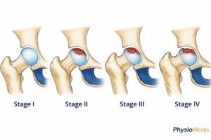 Avascular necrosis of the femoral head stages showing progressive hip joint damage