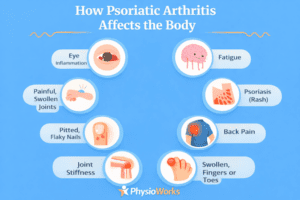 Psoriatic arthritis physiotherapy infographic showing common symptoms across the body
