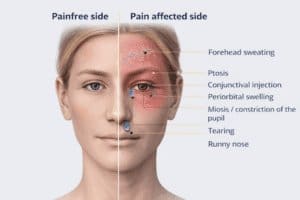 cluster headache pain pattern around eye temple with autonomic symptoms