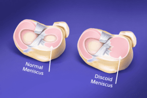 Discoid meniscus compared to normal meniscus knee cartilage