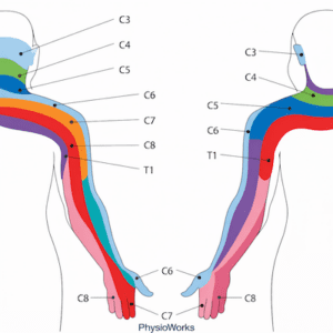 Neck arm pain cervical dermatome referral pattern affecting shoulder arm and hand
