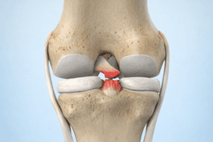 PCL injury posterior knee ligament tear illustration