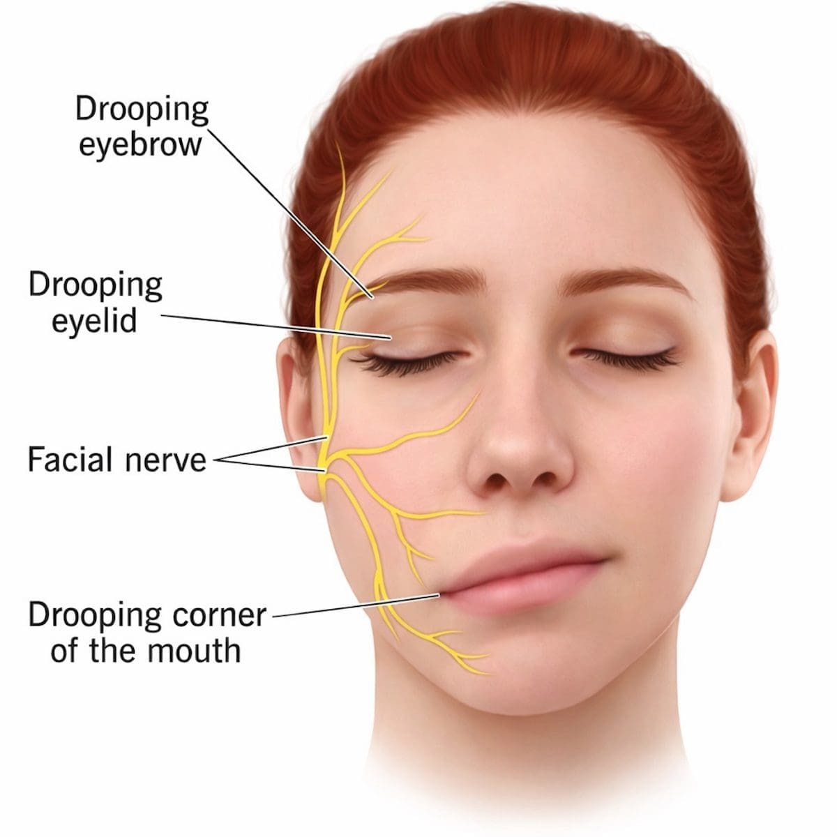 Facial Nerve Palsy Symptoms Facial nerve palsy causing drooping eyelid and mouth in auburn-haired female