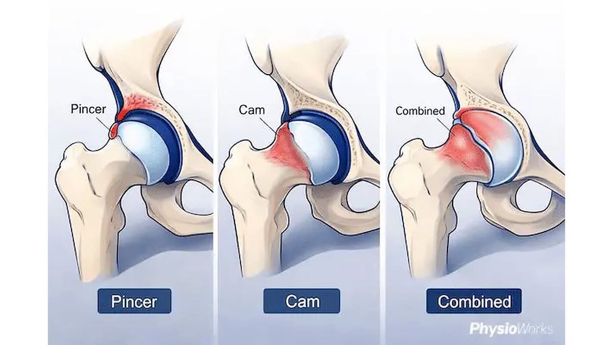 Hip impingement types showing pincer, cam and combined femoroacetabular impingement patterns.